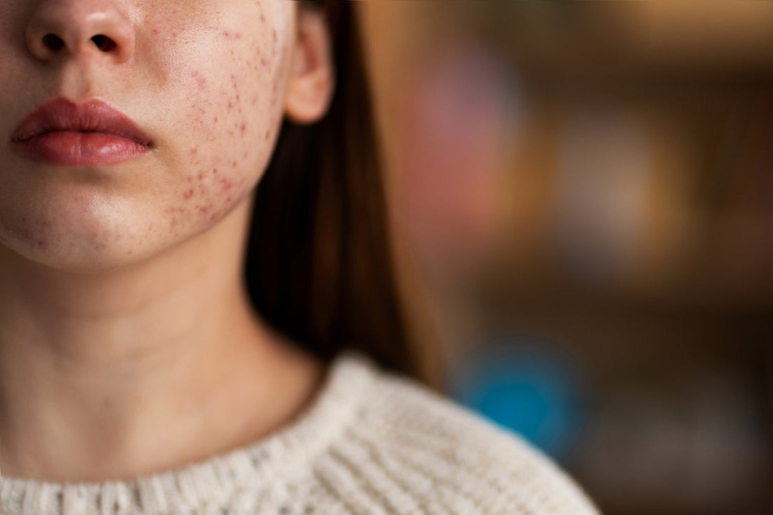 Your Ultimate Guide to Clearing Acne Naturally for Radiant Skin